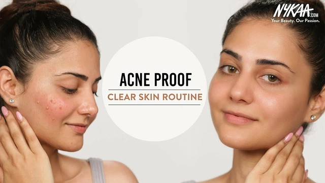 Allantoin for acne-prone skin: does it help or hurt?