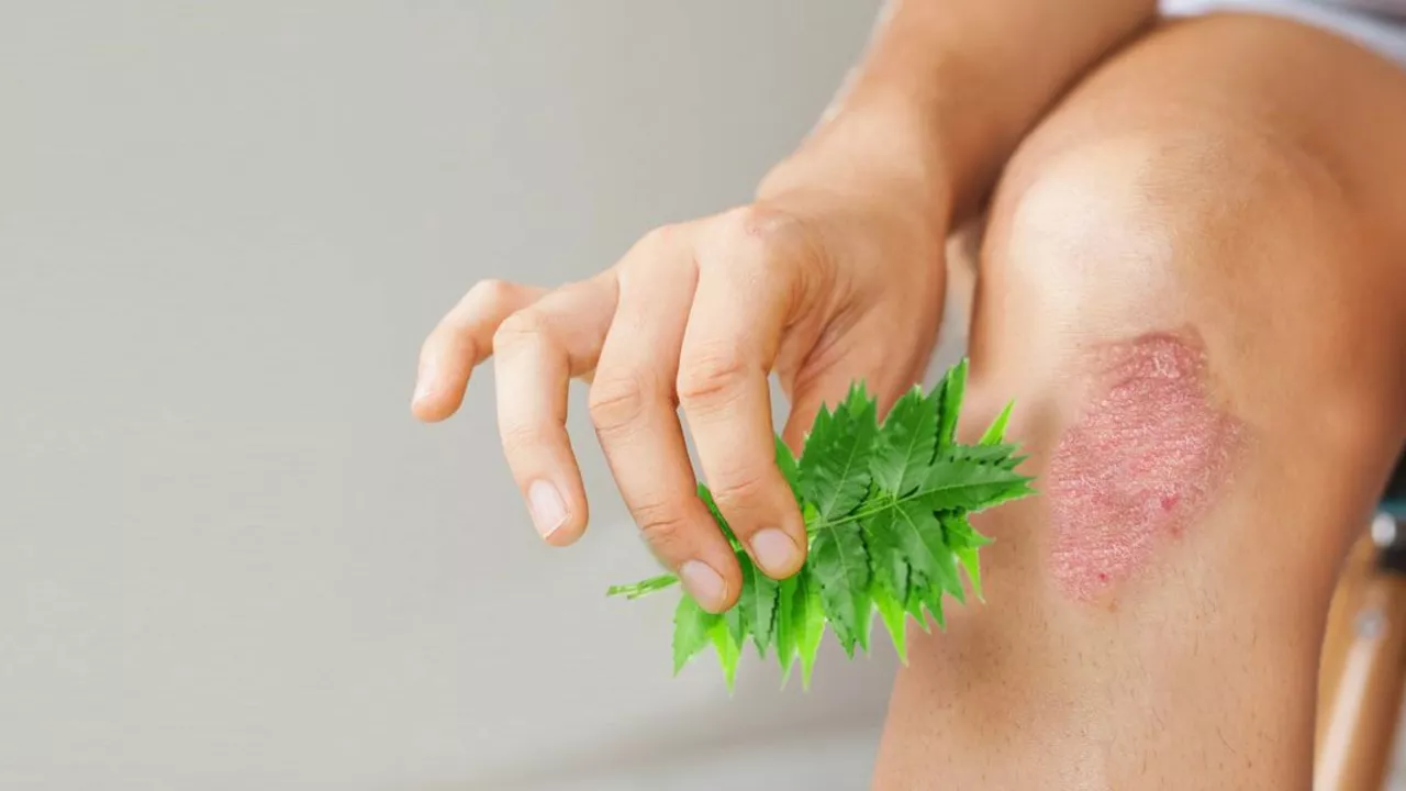 Tazarotene and Eczema: Can It Help Improve Symptoms?